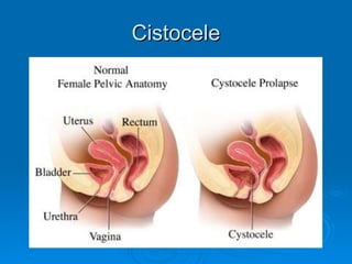 Cistocele 
