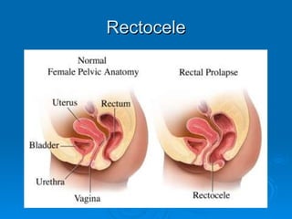 Rectocele 