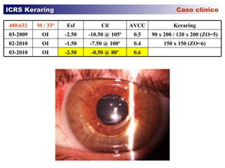 ICRS Keraring    Caso clínico 150 x 150 (ZO=6) 0.4 -7.50 @ 100º -1.50 OI 02-2010 0.6 -0.50 @ 80º -2.50 OI 03-2010 90 x 200 / 120 x 200 (ZO=5) 0.5 -10.50 @ 105º -2.50 OI 03-2009 Keraring AVCC Cil Esf M / 33ª 480.632 