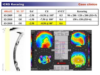 ICRS Keraring    Caso clínico 150 x 150 (ZO=6) 0.4 -7.50 @ 100º -1.50 OI 02-2010 0.6 -0.50 @ 80º -2.50 OI 03-2010 90 x 200 / 120 x 200 (ZO=5) 0.5 -10.50 @ 105º -2.50 OI 03-2009 Keraring AVCC Cil Esf M / 33ª 480.632 