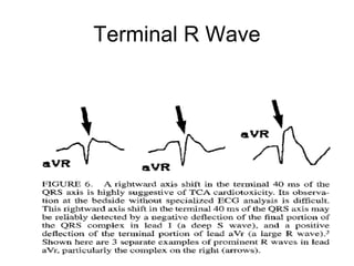 Terminal R Wave
 