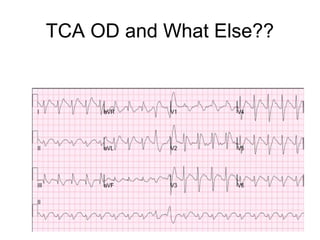 TCA OD and What Else??
 