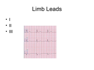 Limb Leads
• I
• II
• III
 