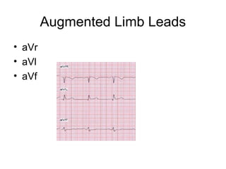 Augmented Limb Leads
• aVr
• aVl
• aVf
 