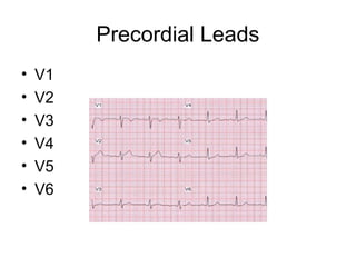Precordial Leads
• V1
• V2
• V3
• V4
• V5
• V6
 