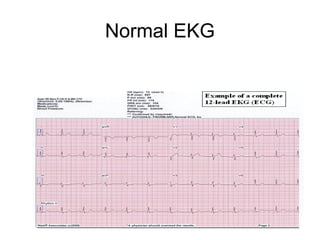 Normal EKG
 