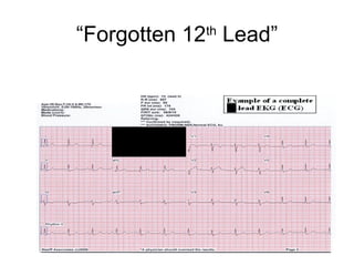 “Forgotten 12th
Lead”
11
 