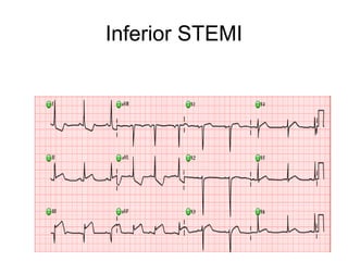 Inferior STEMI
 