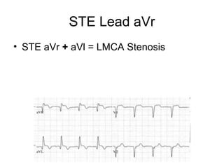 STE Lead aVr
• STE aVr + aVl = LMCA Stenosis
 