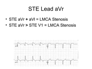 STE Lead aVr
• STE aVr + aVl = LMCA Stenosis
• STE aVr > STE V1 = LMCA Stenosis
 