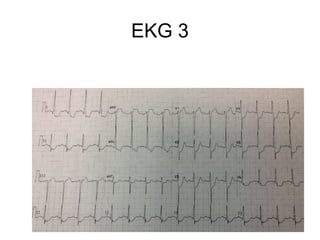 EKG 3
 
