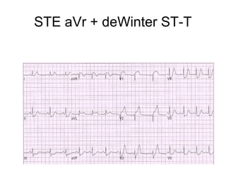 STE aVr + deWinter ST-T
 