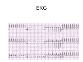 EKG
 