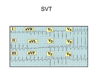 SVT
 