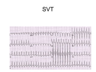 SVT
 