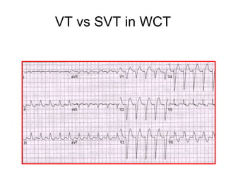 VT vs SVT in WCT
 