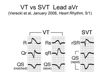 VT vs SVT Lead aVr
(Verecki et al, January 2008, Heart Rhythm, 5/1)
 