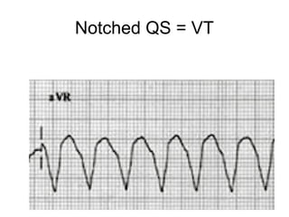 Notched QS = VT
 
