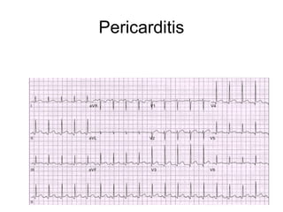 Pericarditis
 
