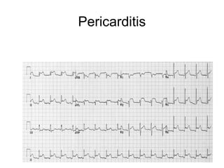 Pericarditis
 