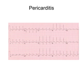 Pericarditis
 