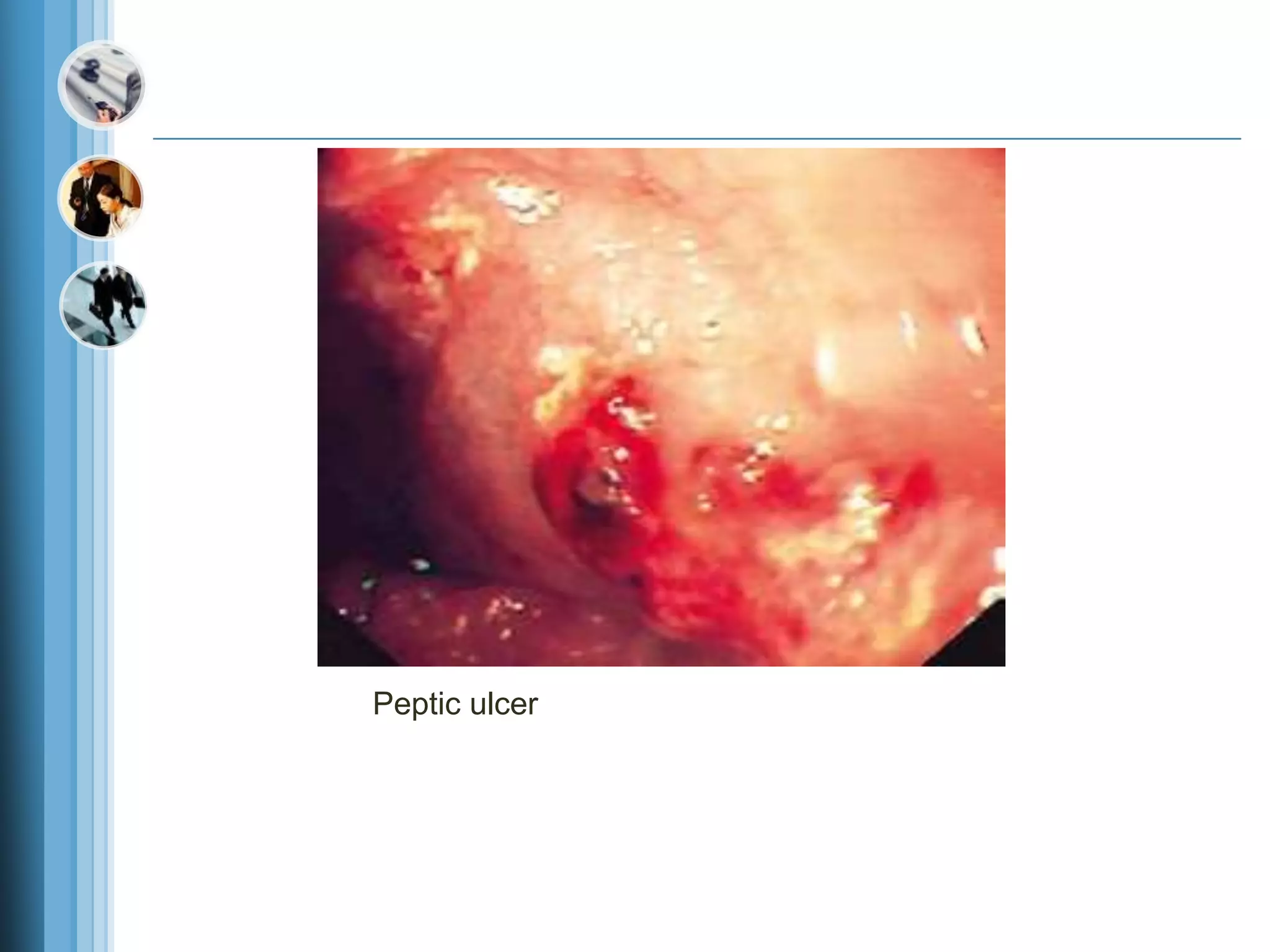 Peptic ulcer
 