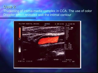 Case 2.Case 2.
Thickening of intima-media complex in CCA. The use of color
Doppler effect revealed well the intimal contour
 