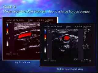 Case 3.Case 3.
Mean eccentric CCA stenosisMean eccentric CCA stenosis due to a large fibrous plaquedue to a large fibrous plaque
A) Axial view
B) Cross-sectional view
 