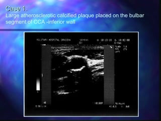 Case 1.Case 1.
Large atherosclerotic calcified plaque placed on the bulbar
segment of CCA -inferior wall
 