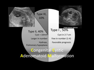 CCAM Congenital Cystic Adenomatoid Malformation | PPTX