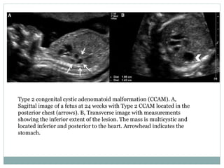 Congenital cystic adenomatoid malformation | PPTX