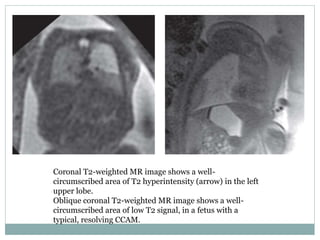 Congenital cystic adenomatoid malformation | PPTX
