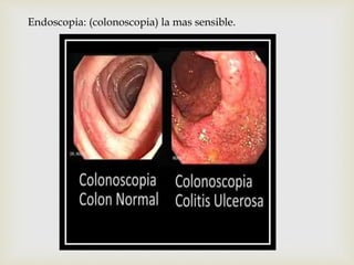 Endoscopia: (colonoscopia) la mas sensible.
 