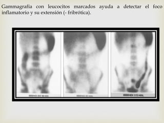 Gammagrafía con leucocitos marcados ayuda a detectar el foco
inflamatorio y su extensión (- fribrótica).
 