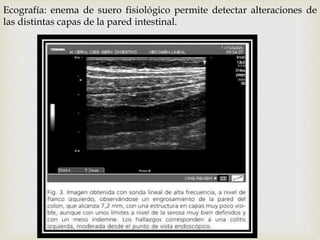 Ecografía: enema de suero fisiológico permite detectar alteraciones de
las distintas capas de la pared intestinal.
 