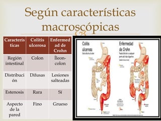 
Según características
macroscópicas
Caracterís
ticas
Colitis
ulcerosa
Enfermed
ad de
Crohn
Región
intestinal
Colon Íleon-
colon
Distribuci
ón
Difusas Lesiones
salteadas
Estenosis Rara Sí
Aspecto
de la
pared
Fino Grueso
 