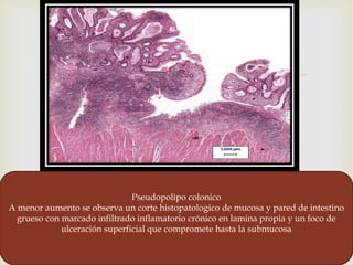 
Pseudopolipo colonico
A menor aumento se observa un corte histopatologico de mucosa y pared de intestino
grueso con marcado infiltrado inflamatorio crónico en lamina propia y un foco de
ulceración superficial que compromete hasta la submucosa
 