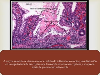 
A mayor aumento se observa mejor el infiltrado inflamatorio crónico, una distorsión
en la arquitectura de las criptas, una formación de abscesos crípticos y se aprecia
tejido de granulación subyacente
 