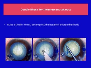 Small Rhexis Contiunous Curvilinear Capsulorhexis .pptx