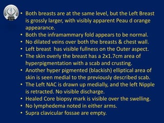 • Both breasts are at the same level, but the Left Breast
is grossly larger, with visibly apparent Peau d orange
appearance.
• Both the inframammary fold appears to be normal.
• No dilated veins over both the breasts & chest wall.
• Left breast has visible fullness on the Outer aspect.
• The skin overly the breast has a 2x1.7cm area of
hyperpigmentation with a scab and crusting.
• Another hyper pigmented (blackish) elliptical area of
skin is seen medial to the previously described scab.
• The Left NAC is drawn up medially, and the left Nipple
is retracted. No visible discharge.
• Healed Core biopsy mark is visible over the swelling.
• No lymphedema noted in either arms.
• Supra clavicular fossae are empty.
 