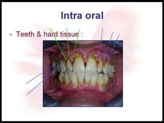 Intra oral