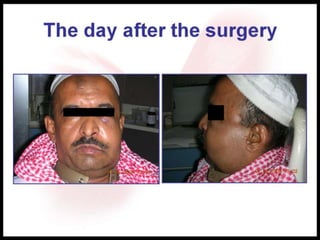 The day after the surgery