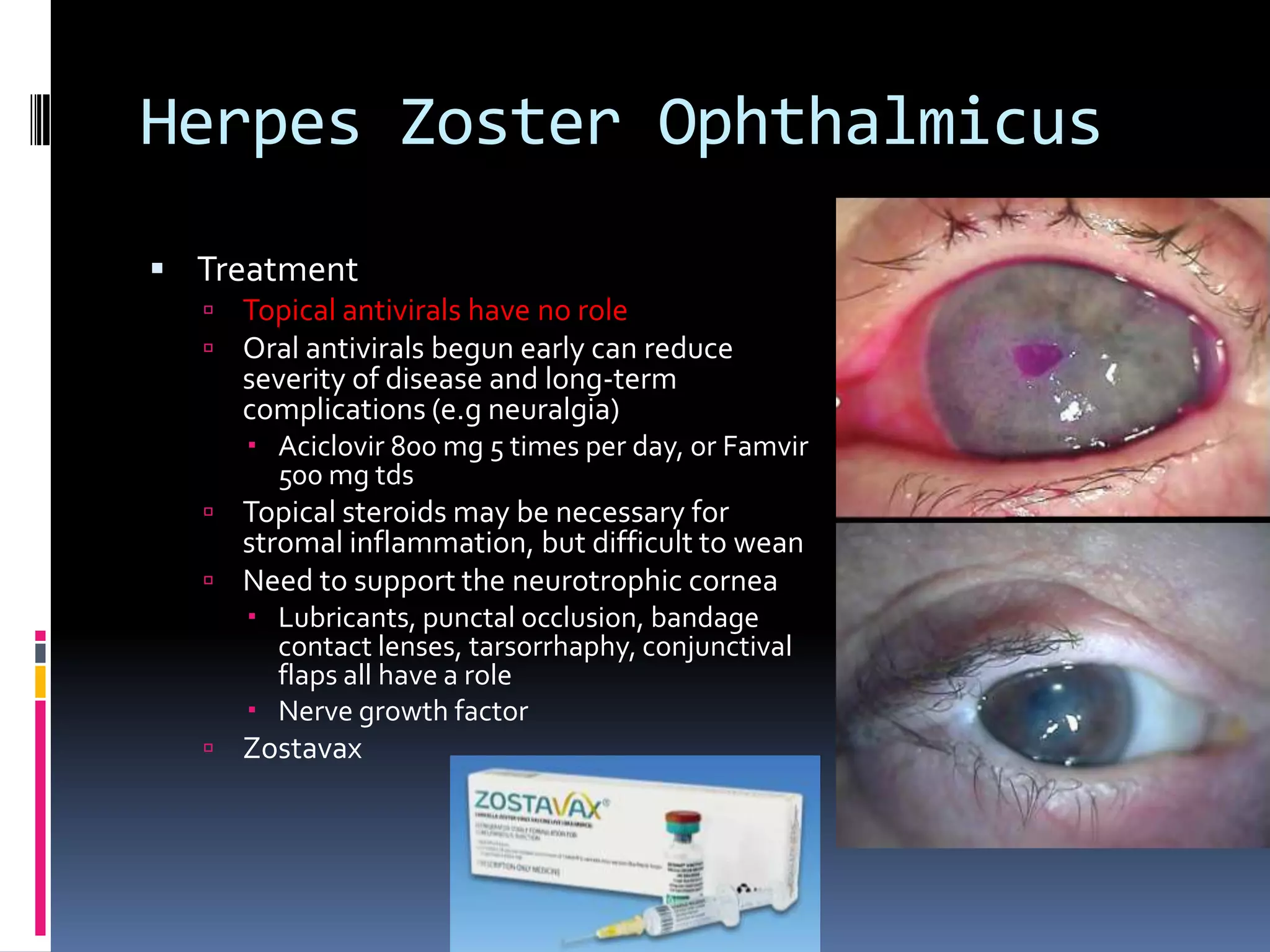 Herpes Zoster Ophthalmicus
 Treatment
 Topical antivirals have no role
 Oral antivirals begun early can reduce
severity of disease and long-term
complications (e.g neuralgia)
 Aciclovir 800 mg 5 times per day, or Famvir
500 mg tds
 Topical steroids may be necessary for
stromal inflammation, but difficult to wean
 Need to support the neurotrophic cornea
 Lubricants, punctal occlusion, bandage
contact lenses, tarsorrhaphy, conjunctival
flaps all have a role
 Nerve growth factor
 Zostavax
 