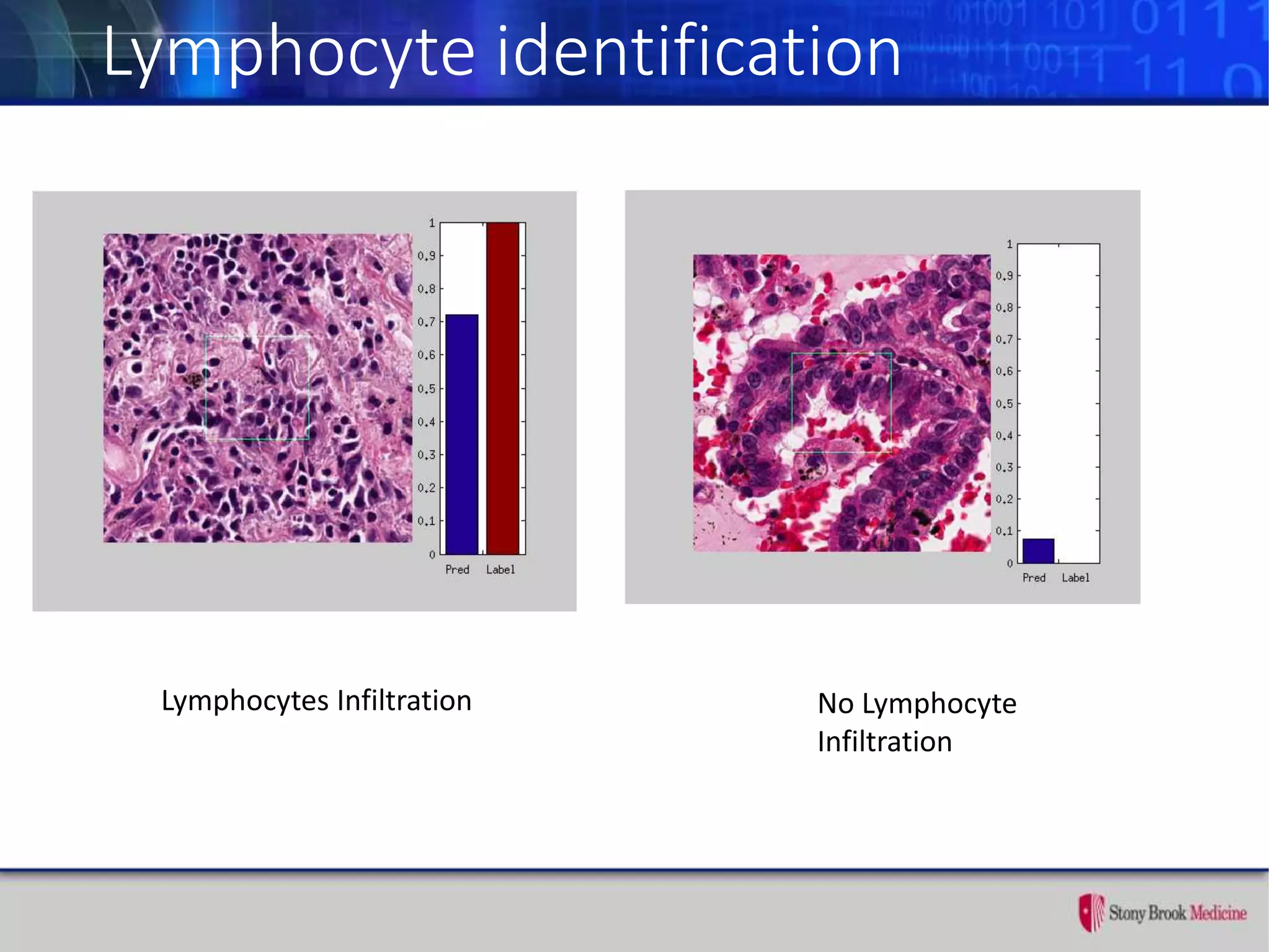 Lymphocyte identification
Lymphocytes Infiltration No Lymphocyte
Infiltration
 