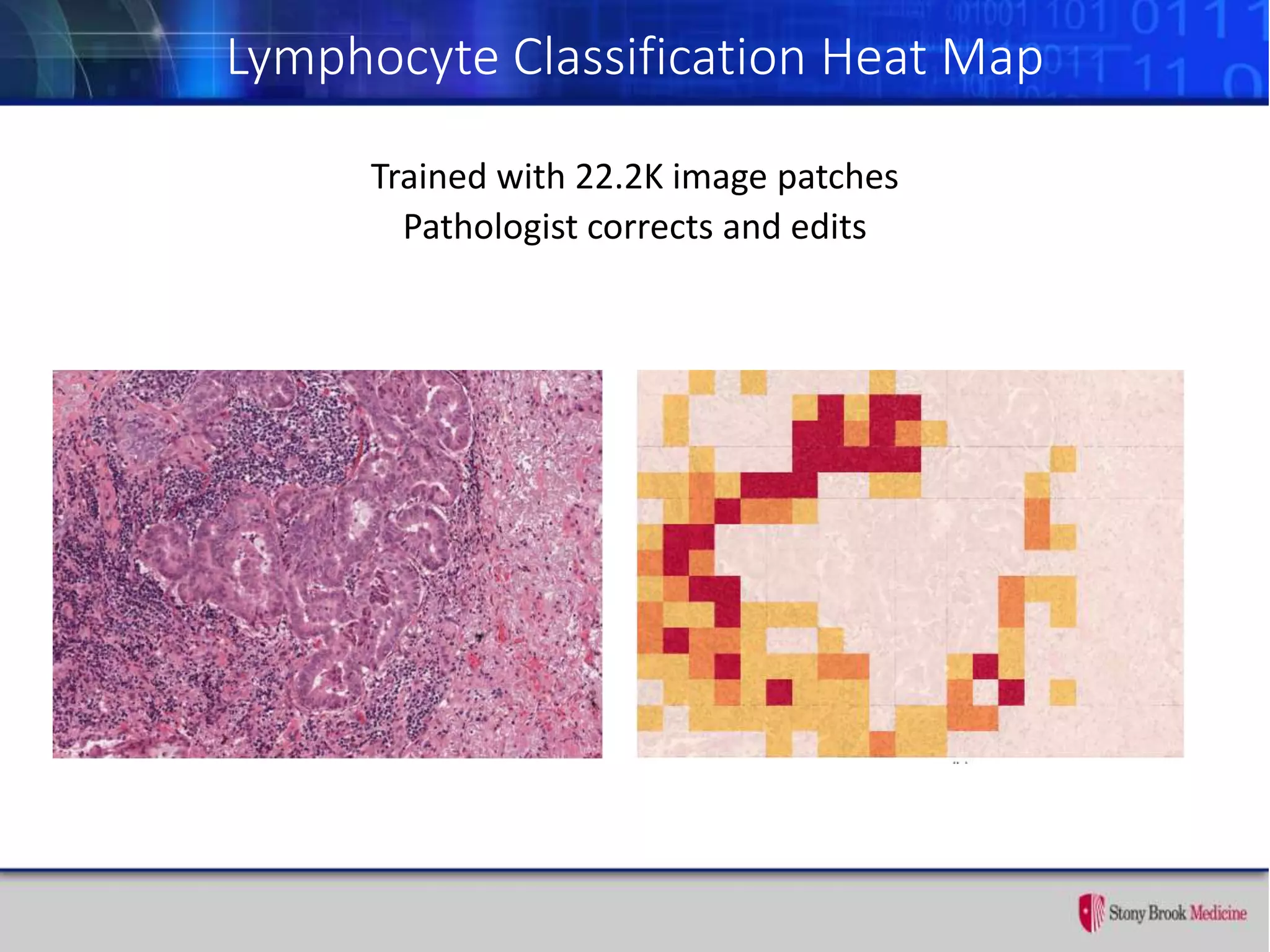Lymphocyte Classification Heat Map
Trained with 22.2K image patches
Pathologist corrects and edits
 