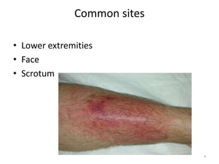 Common sites
• Lower extremities
• Face
• Scrotum
4
 