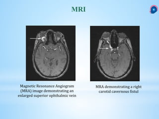 Caroticocavernous fistula CCF | PPTX