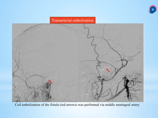 Caroticocavernous fistula CCF | PPTX