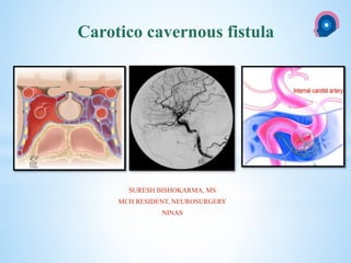 cka
SURESH BISHOKARMA, MS
MCH RESIDENT, NEUROSURGERY
NINAS
Carotico cavernous fistula
 