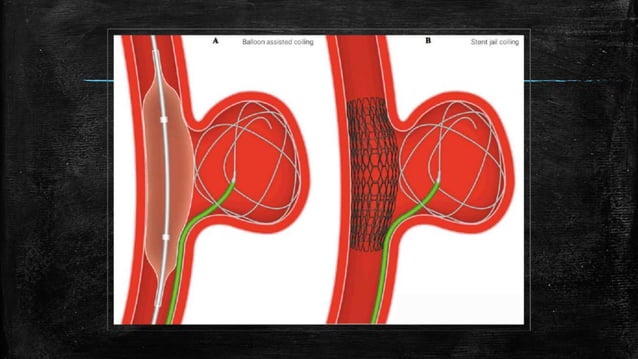 Carotid cavernous fistula | PPTX
